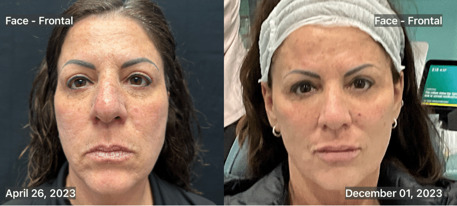 Before & After: 8 months after Exosome Facelift with Radiesse and Volbella (lips)