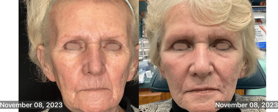 Before - Immediately after Exosome facelift with Radiesse
