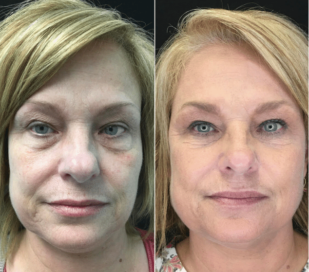 Before & After: Two years following Vampire facelift with filler and Vampire microneedling (series of 3)