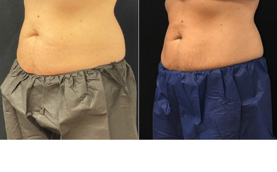 Before & After: Over 12 weeks following Coolsculpting ABDOMEN and FLANKS second session