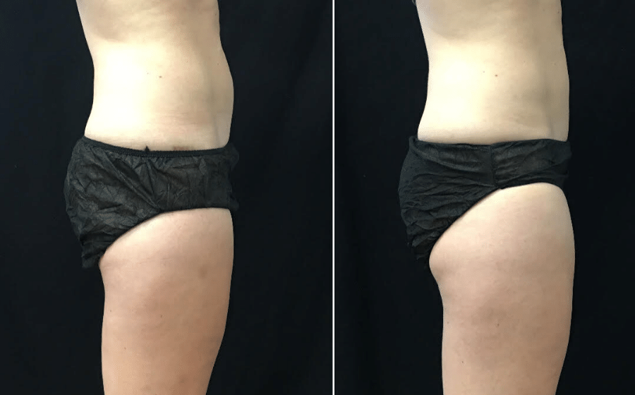 Before & After: Coolsculpting ABDOMEN 12 weeks after second session