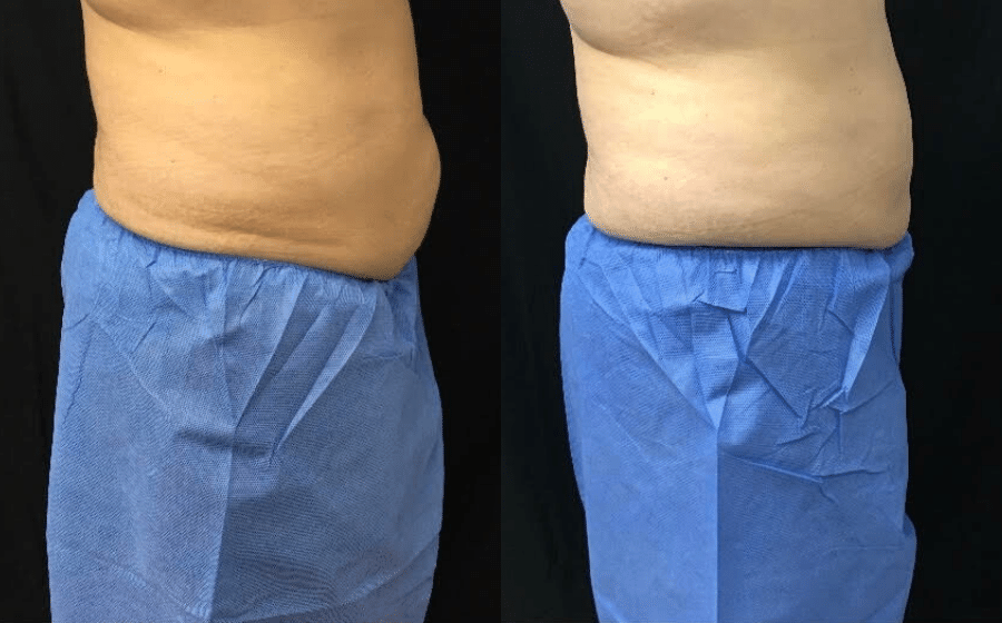 Before & After: 12 weeks following second session of Coolsculpting abdomen