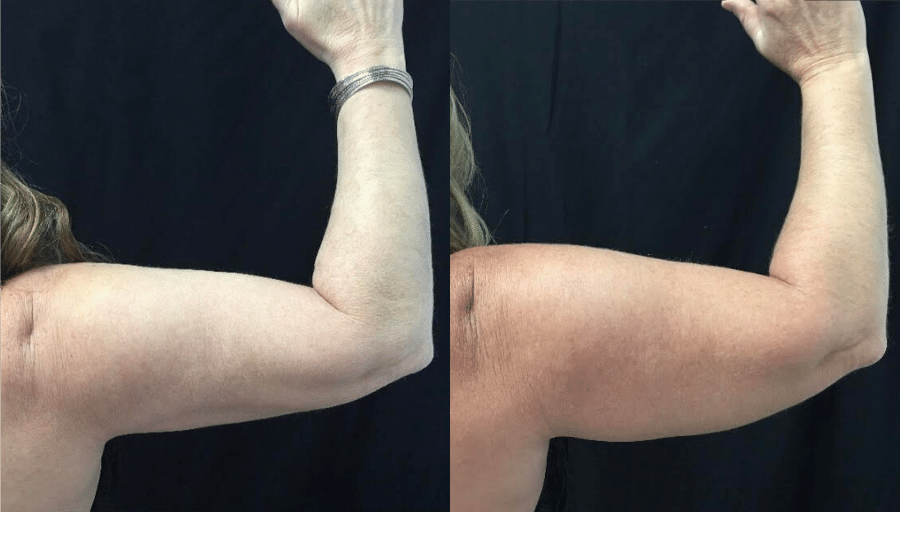 Before & After: Eight months following Coolsculpting  second session