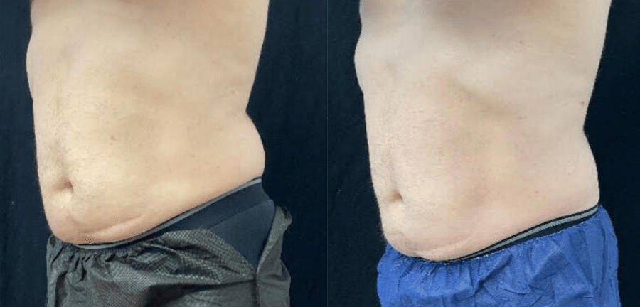 Before & After: 12 weeks after Coolsculpting flanks second session