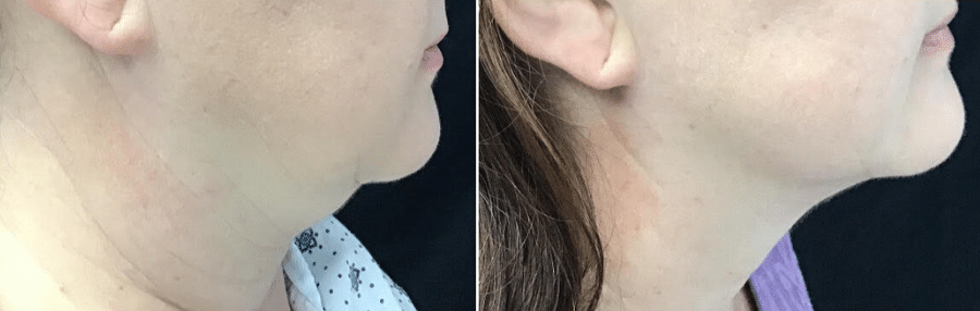 Before & After: Coolsculpting Chin, over 12 weeks following two sessions