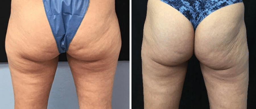 Before & After: Over 12 weeks following Coolsculpting saddlebags second session
