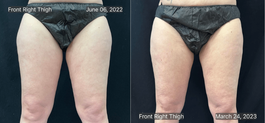 Before & After: Nine months after Coolsculpting second session