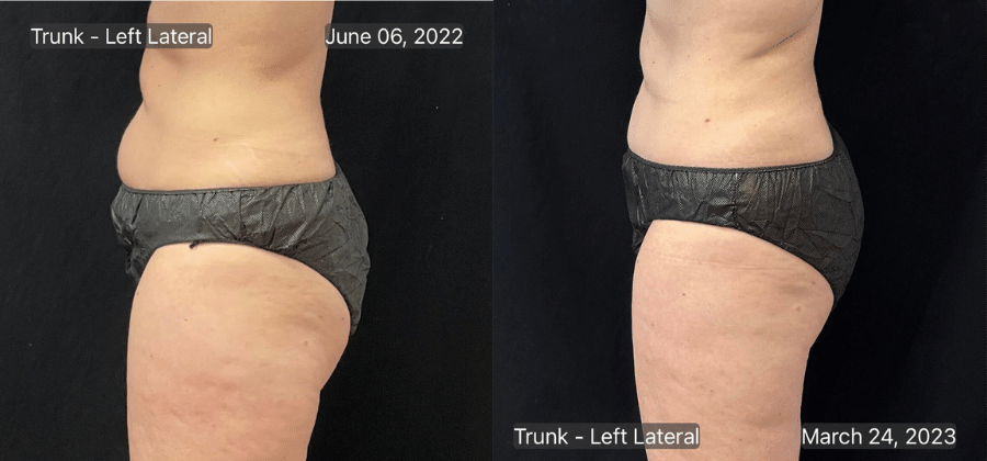 Before & After: Nine months after Coolsculpting abdomen second session