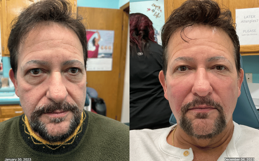 Before & After: Exosomes Facelift with Radiesse