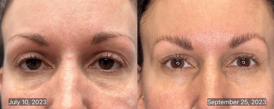 Before & After: 10 weeks following under eye exosome injection