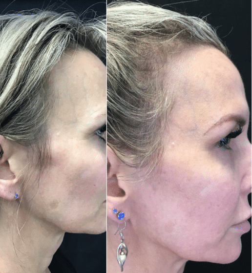 Before & After one treatment of IPL Laser on Brown Spot