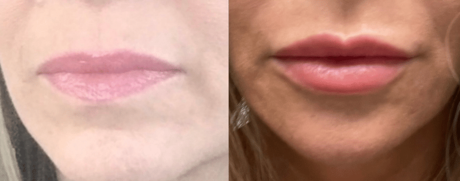 Before & After Juvederm Ultra XC Lip Filler