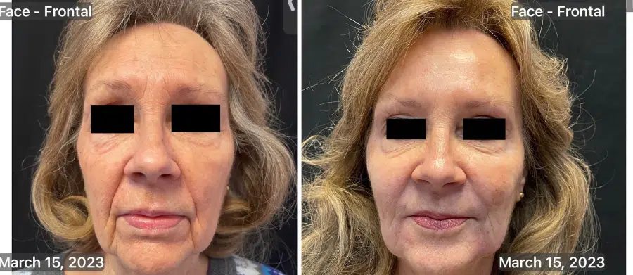 Filler-Juvederm-e1703257446494