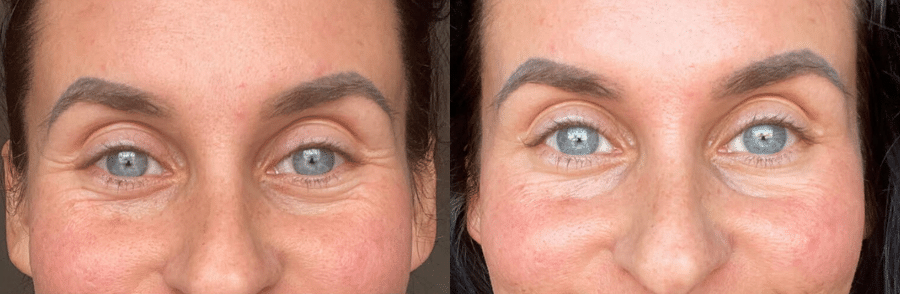 botox-e1702342187338